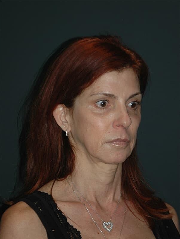 Blepharoplasty Before & After