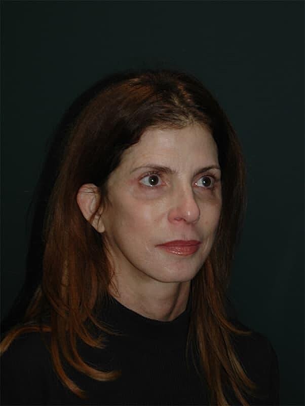 Blepharoplasty Before & After