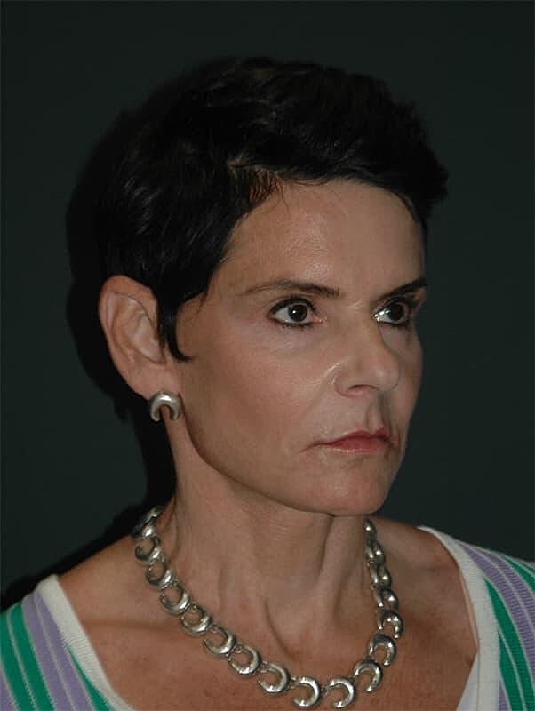Blepharoplasty Before & After