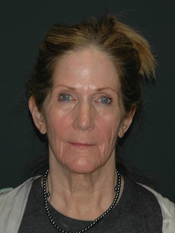 Blepharoplasty Before & After
