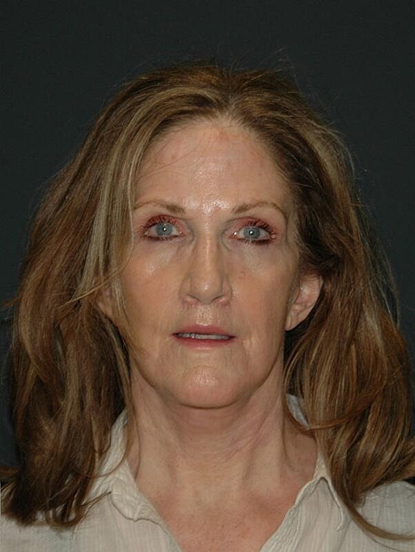 Blepharoplasty Before & After
