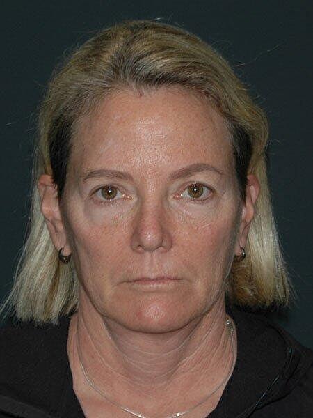 Blepharoplasty Before & After
