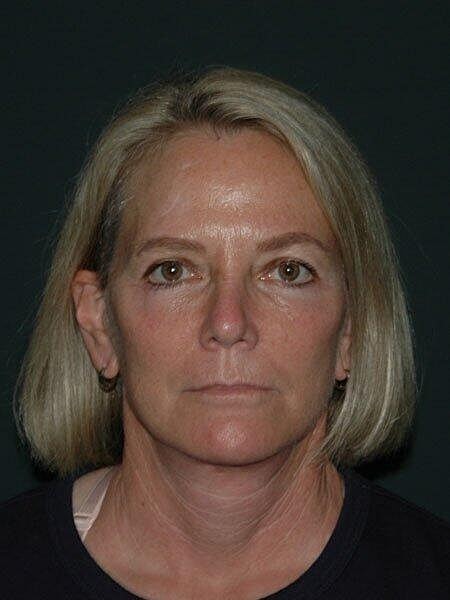 Blepharoplasty Before & After