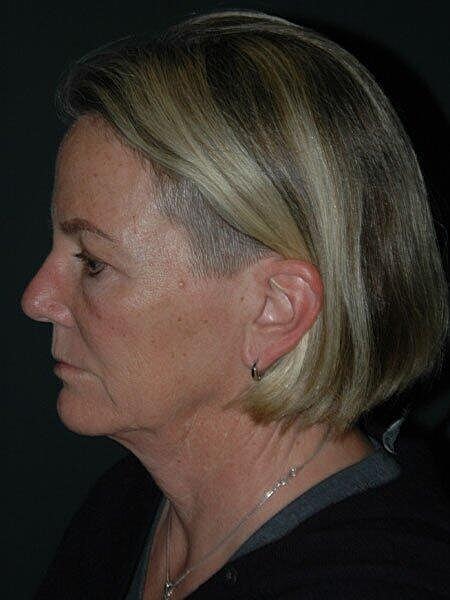 Blepharoplasty Before & After