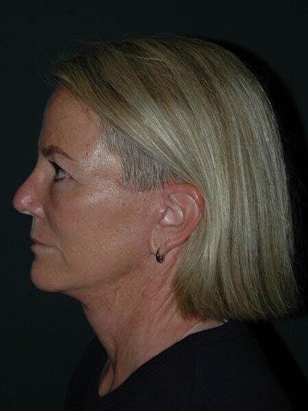 Blepharoplasty Before & After