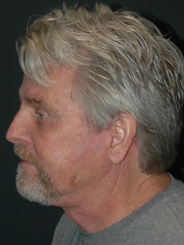 Blepharoplasty Before & After