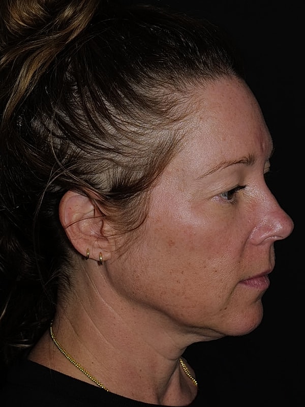 Blepharoplasty Before & After