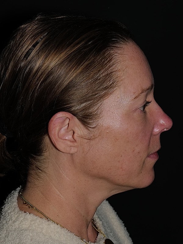 Blepharoplasty Before & After