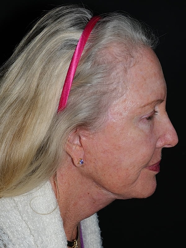 Blepharoplasty Before & After