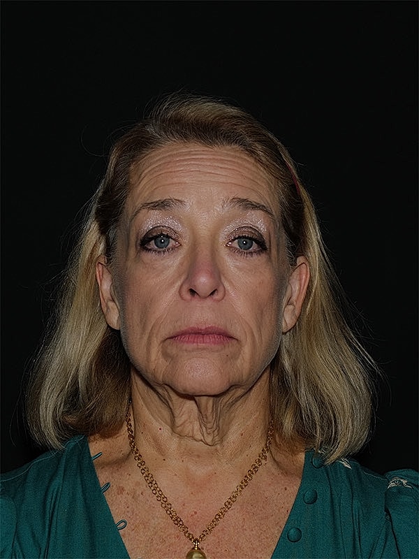 Facelift Neck Lift Before & After