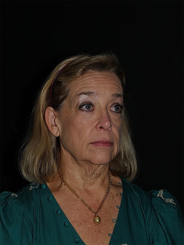 Facelift Neck Lift Before & After