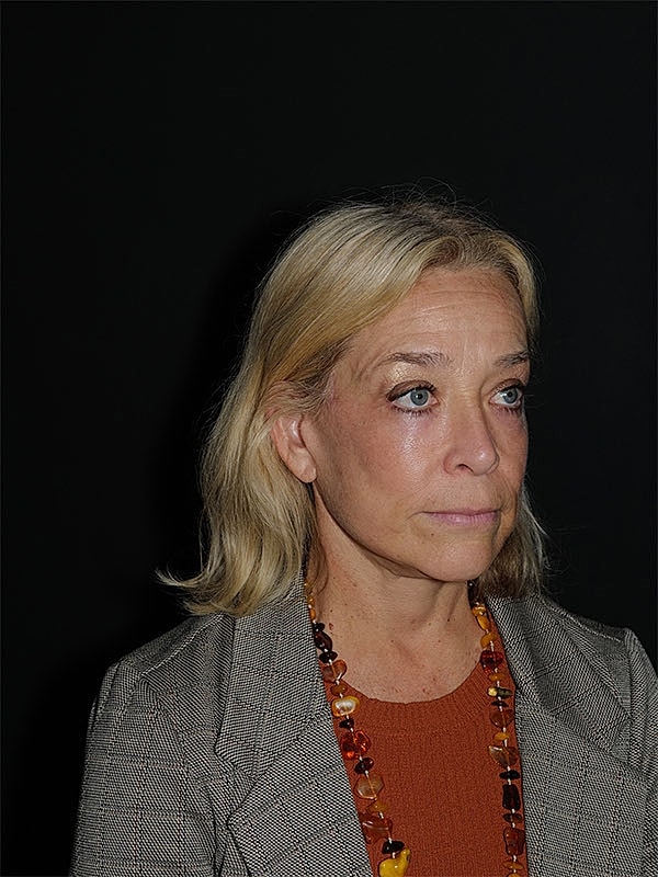 Facelift Neck Lift Before & After