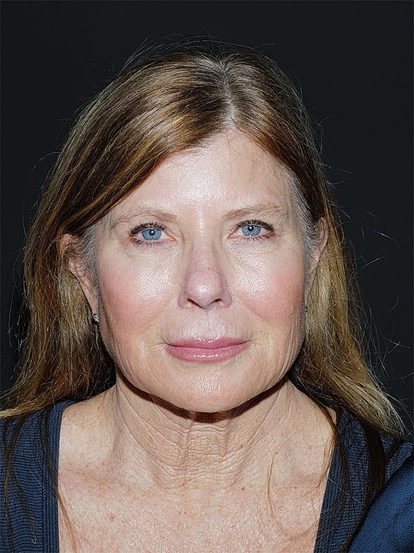 Facelift Neck Lift Before & After