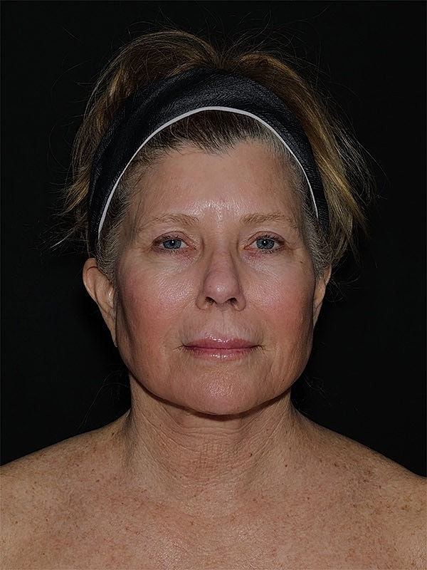Facelift Neck Lift Before & After
