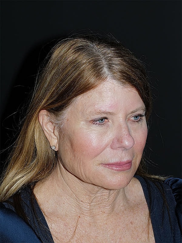 Facelift Neck Lift Before & After