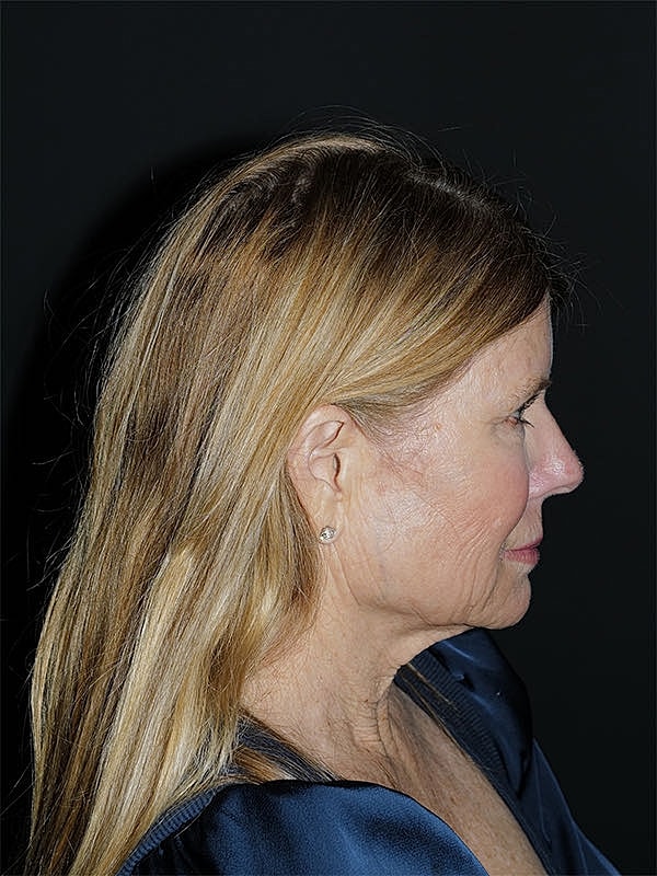 Facelift Neck Lift Before & After