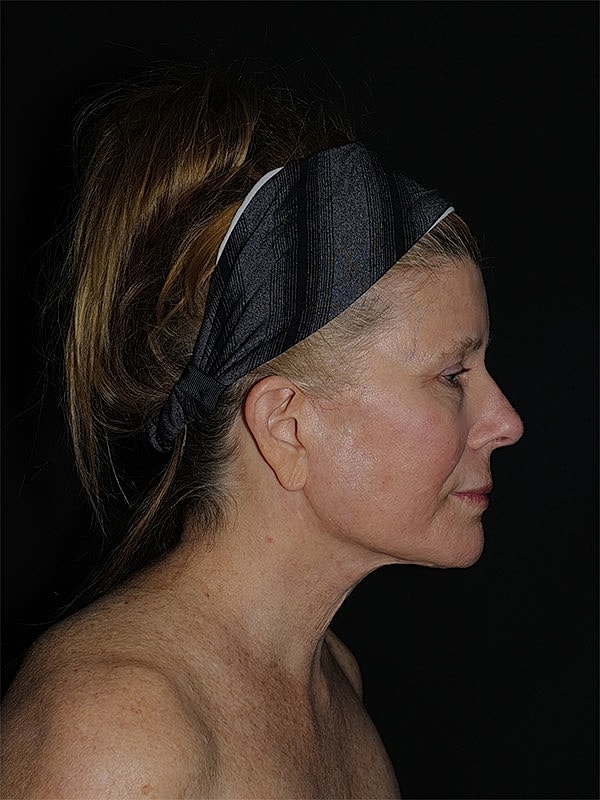 Facelift Neck Lift Before & After
