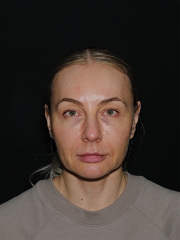 Facelift Neck Lift Before & After