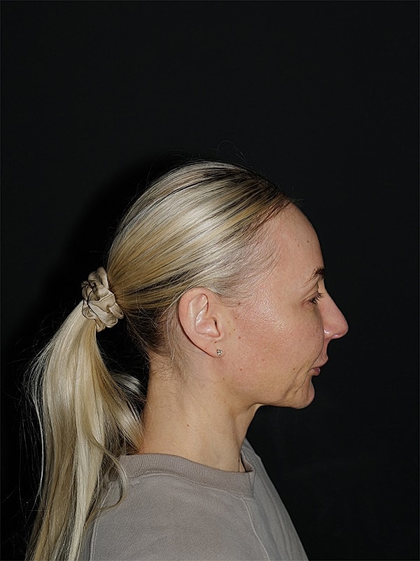 Facelift Neck Lift Before & After
