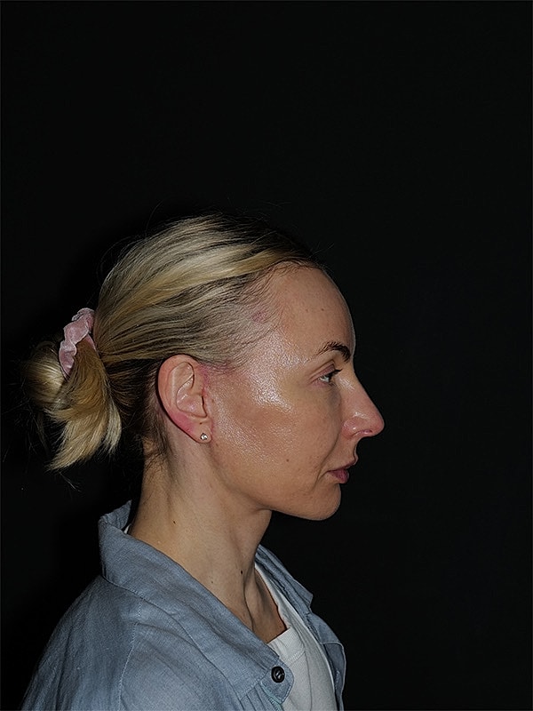 Facelift Neck Lift Before & After