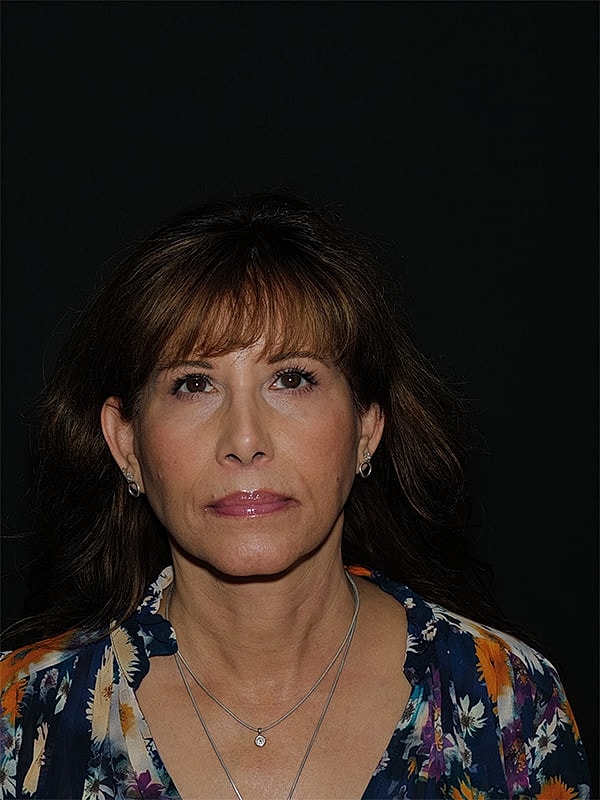 Facelift Neck Lift Before & After