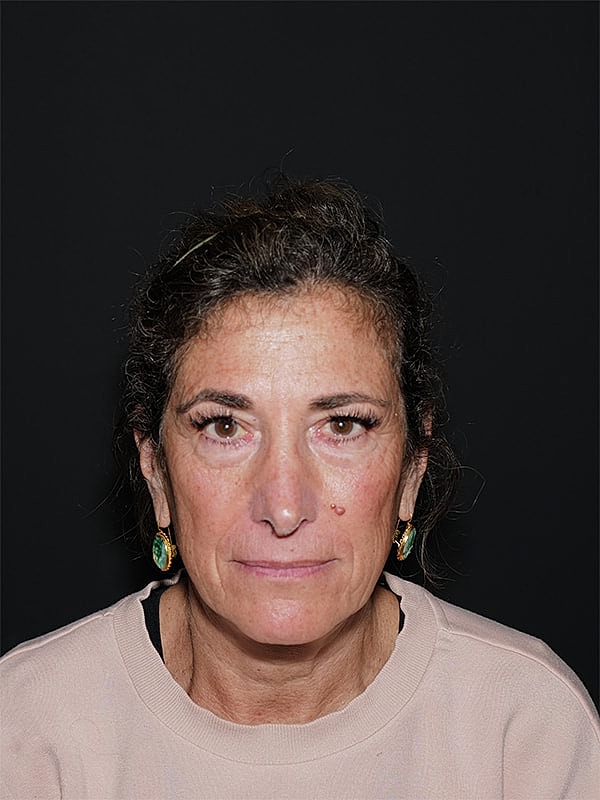 Facelift Neck Lift Before & After