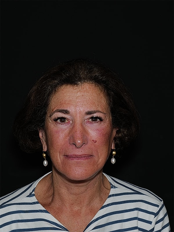 Facelift Neck Lift Before & After