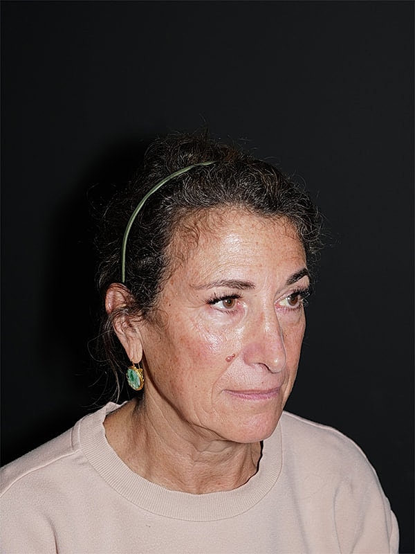Facelift Neck Lift Before & After