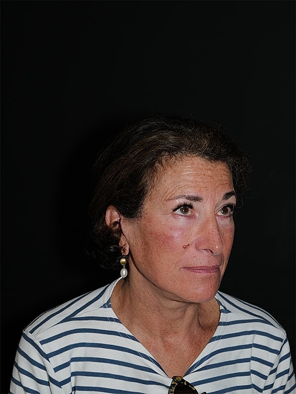 Facelift Neck Lift Before & After