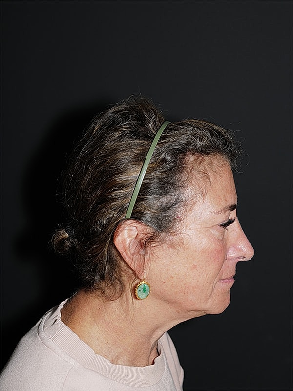 Facelift Neck Lift Before & After
