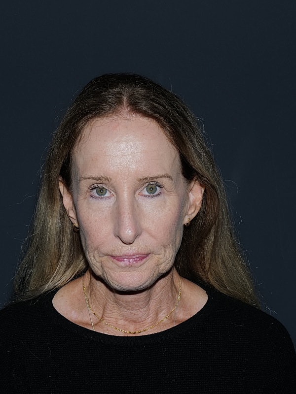 Facelift Neck Lift Before & After