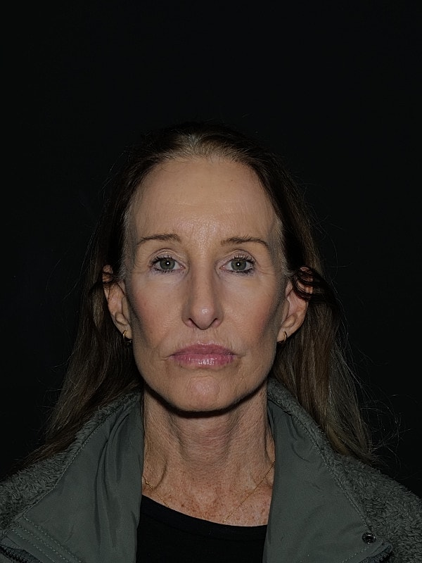 Facelift Neck Lift Before & After