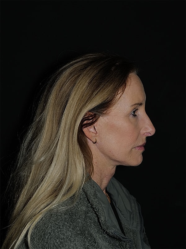 Facelift Neck Lift Before & After