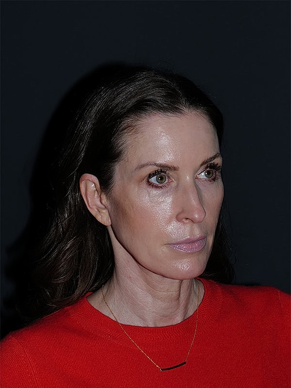 Facelift Neck Lift Before & After