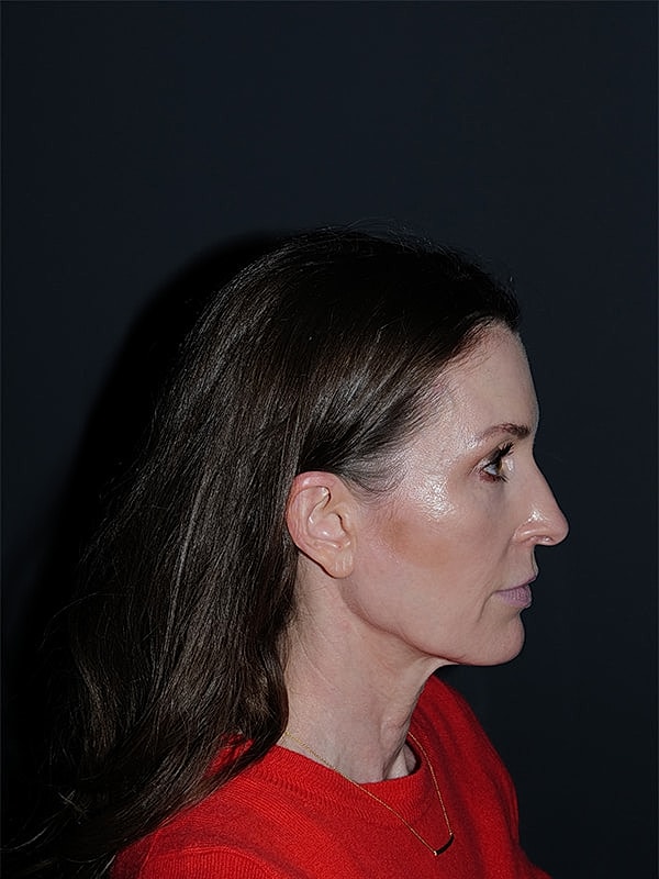 Facelift Neck Lift Before & After