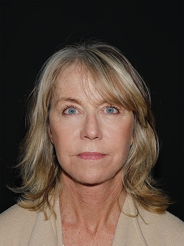 Facelift Neck Lift Before & After