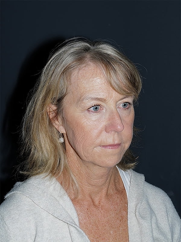 Facelift Neck Lift Before & After