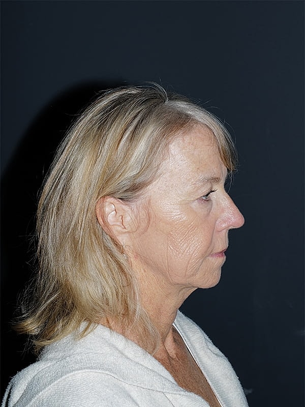 Facelift Neck Lift Before & After