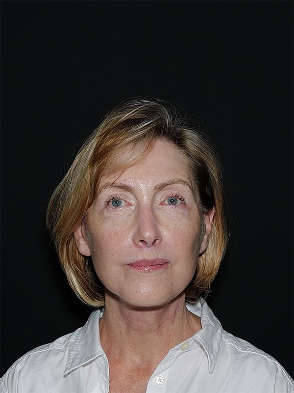 Facelift Neck Lift Before & After