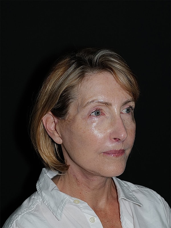 Facelift Neck Lift Before & After