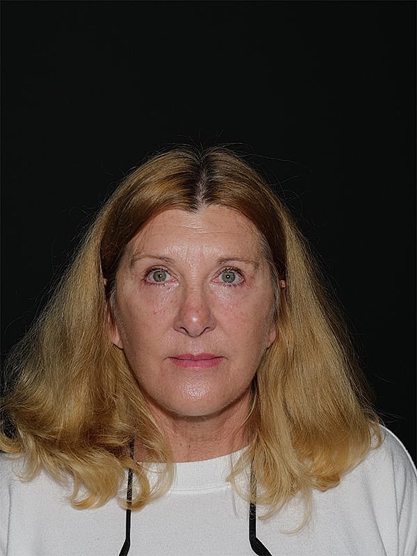 Facelift Neck Lift Before & After