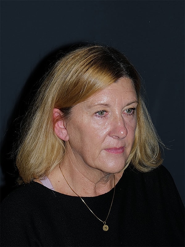 Facelift Neck Lift Before & After