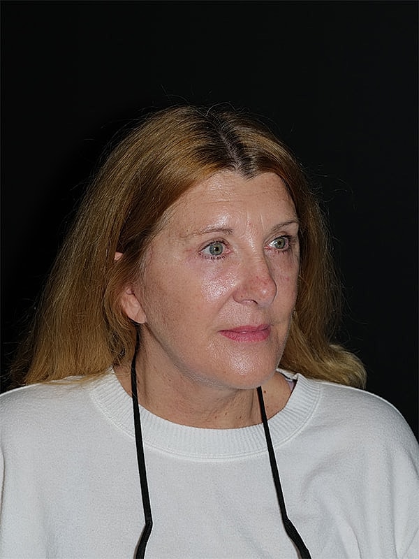 Facelift Neck Lift Before & After