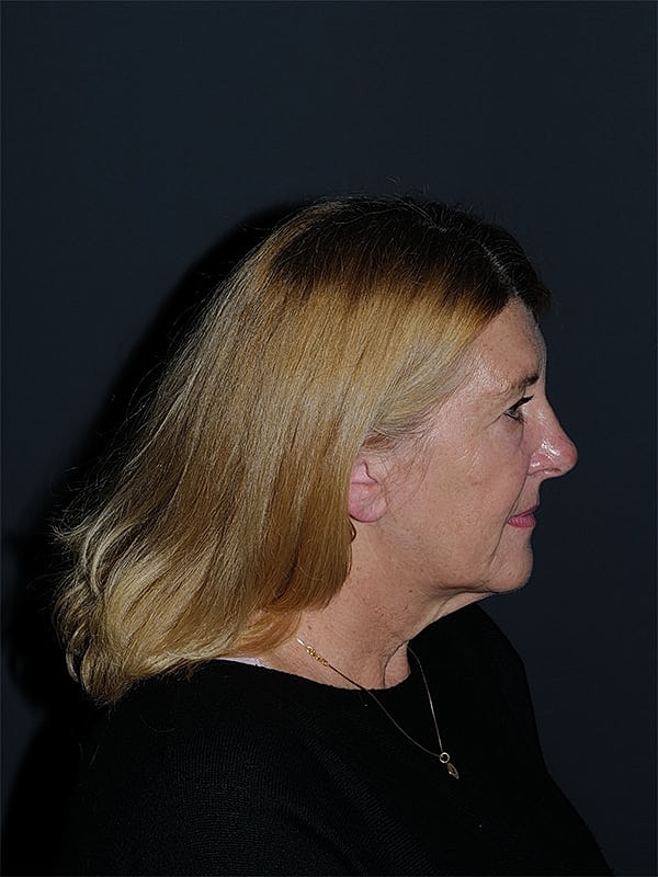 Facelift Neck Lift Before & After