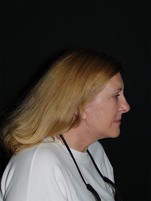 Facelift Neck Lift Before & After