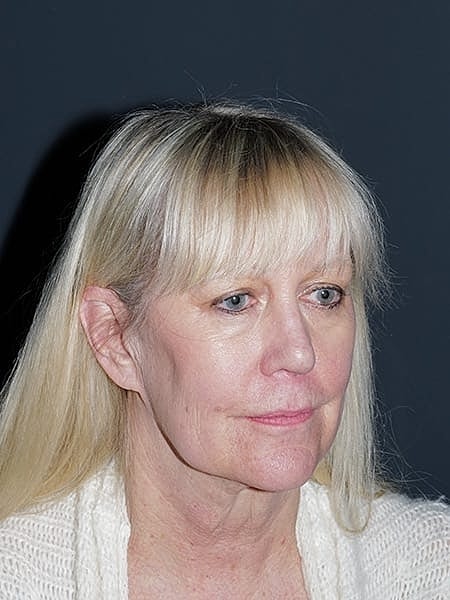 Facelift Neck Lift Before & After