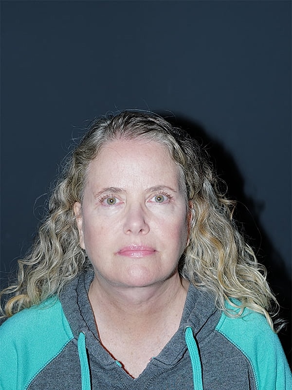 Facelift Neck Lift Before & After