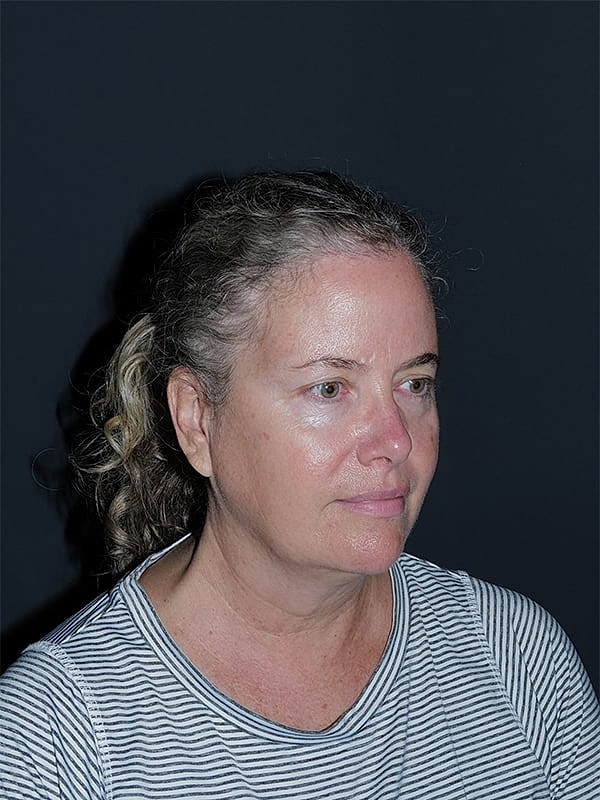 Facelift Neck Lift Before & After
