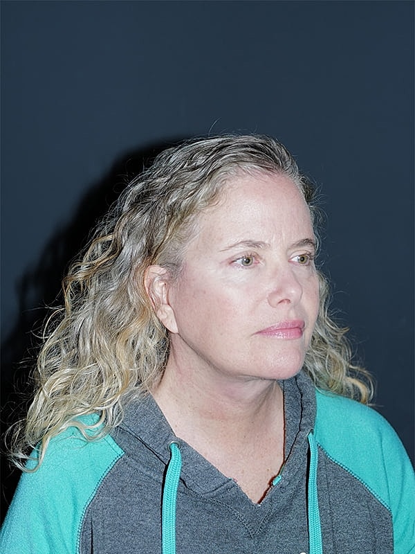 Facelift Neck Lift Before & After