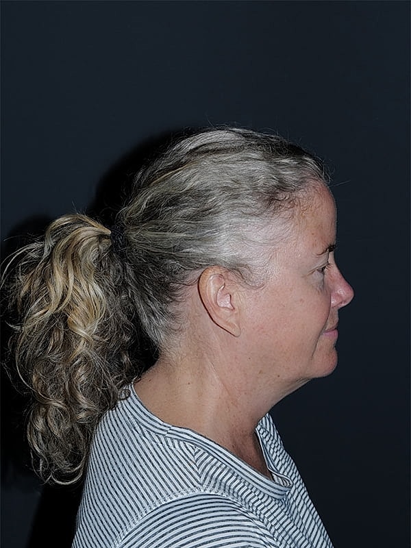 Facelift Neck Lift Before & After